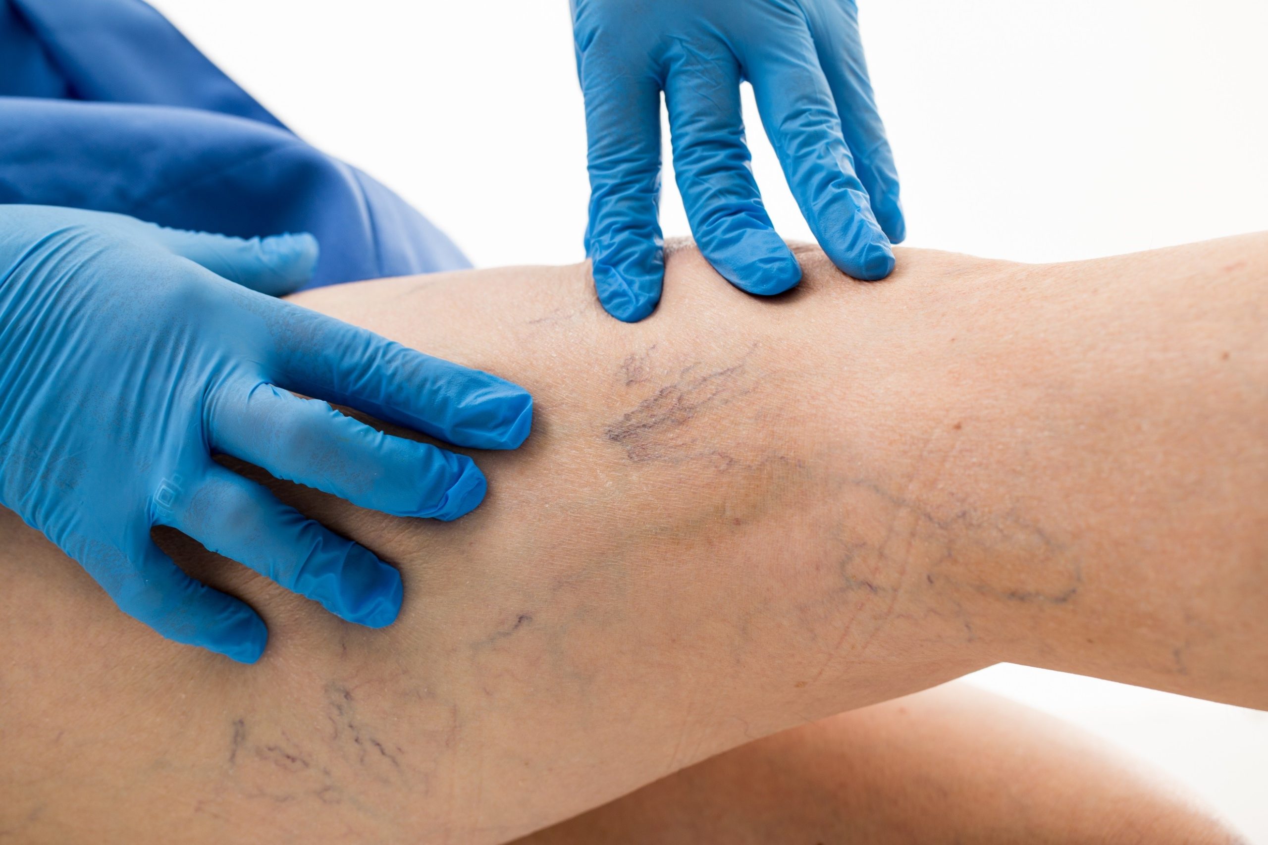 Boost Your Confidence With Vein Therapy In Dallas